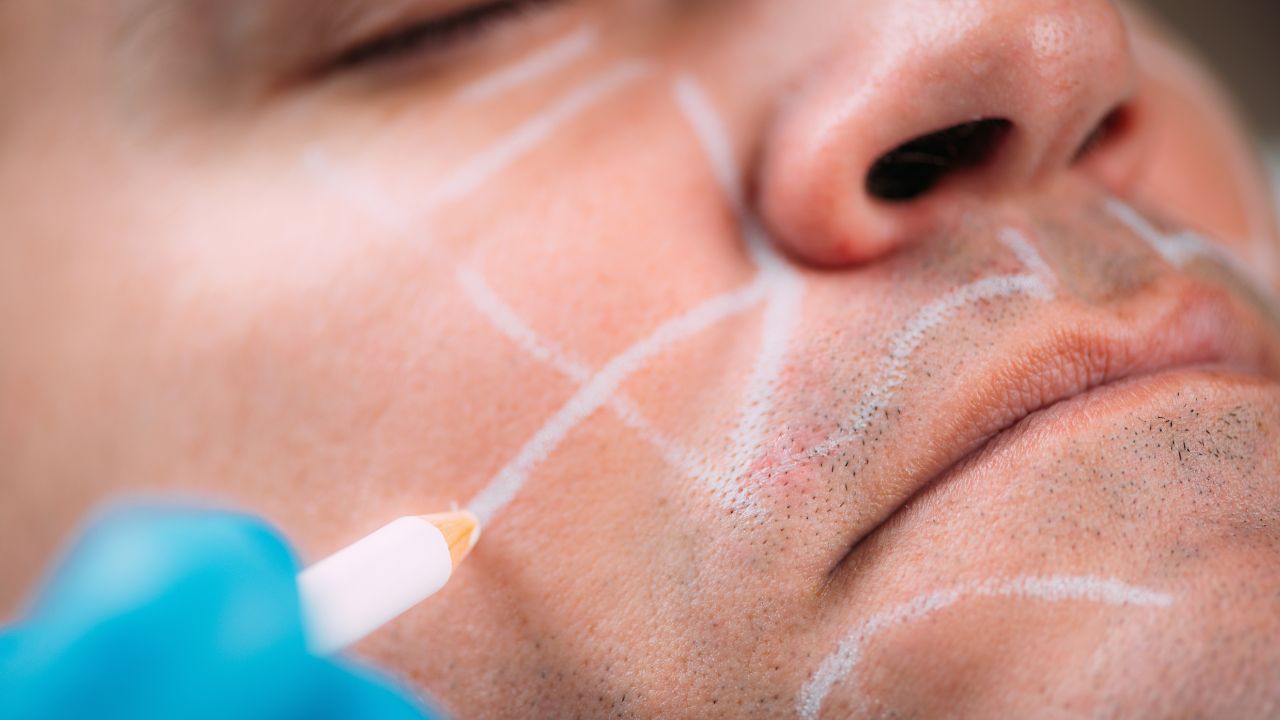 Facial Contouring