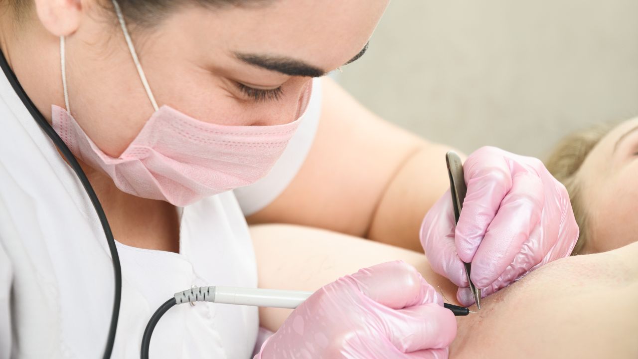 Permanent Hair Reduction