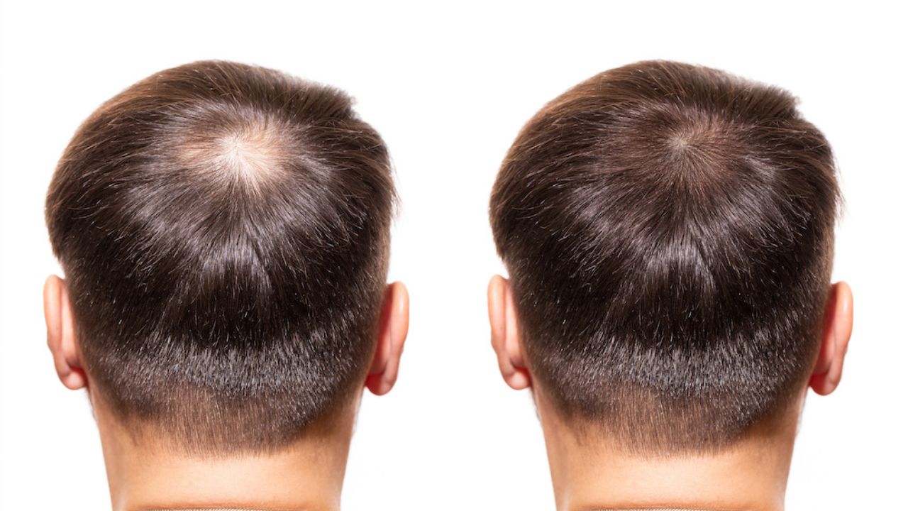 PRP Hair Treatment