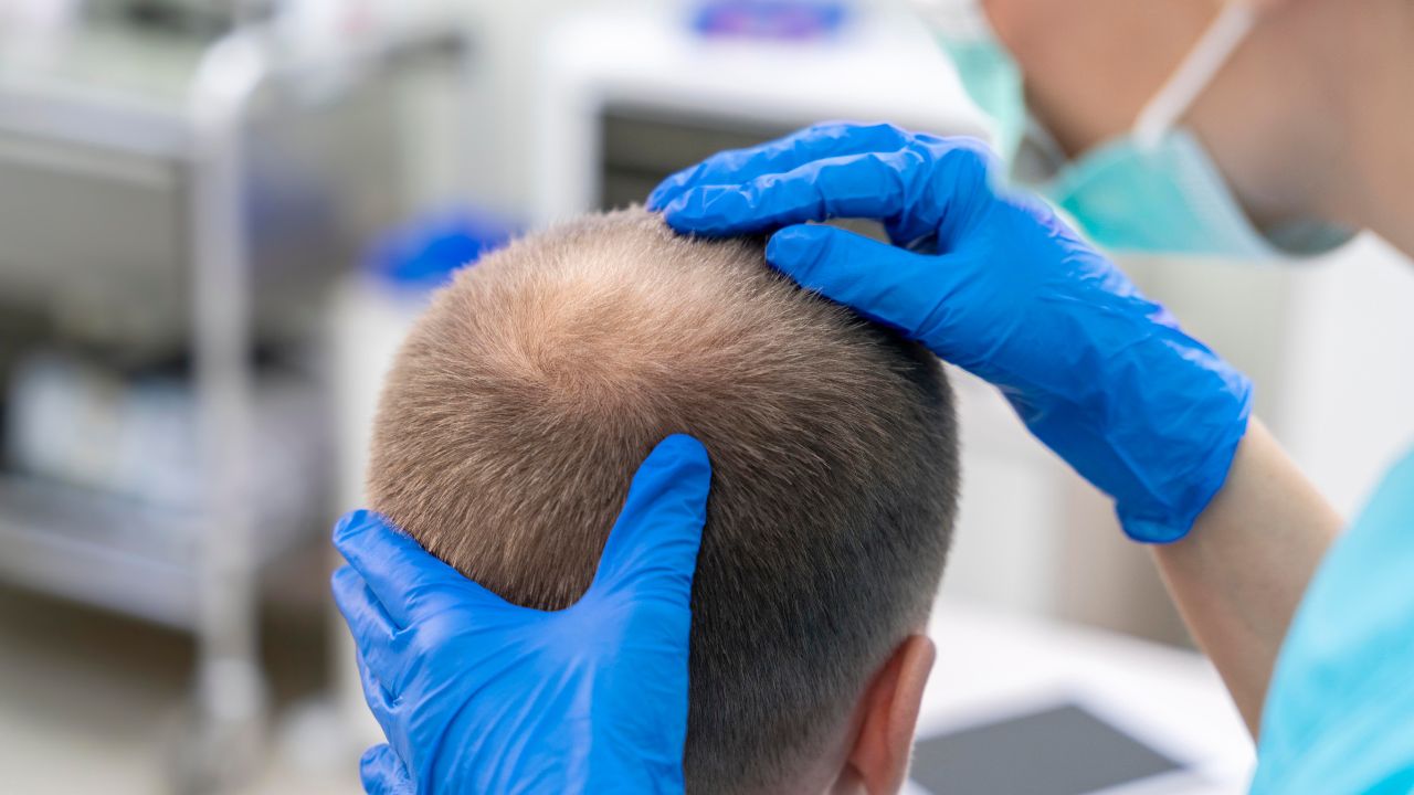 PRP Hair Treatment